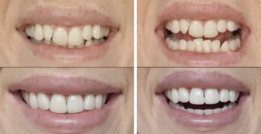 Dental treatment before and after result 1